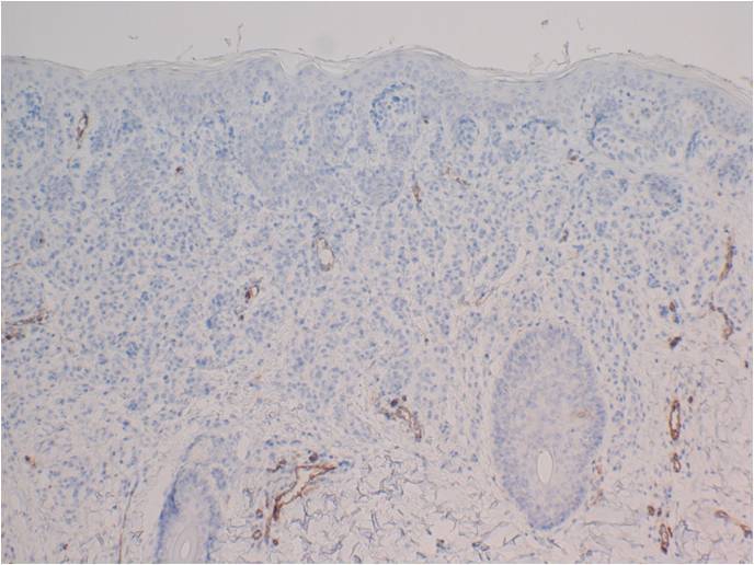 Figure 6. Right patietal scalp, CD123, 4x